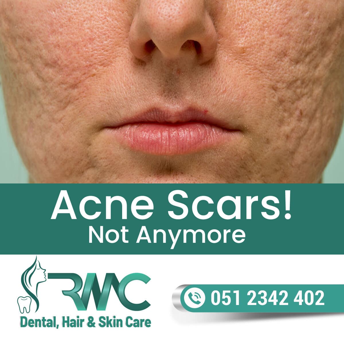 laser-treatment-for-acne-scars-in-islamabad-r-m-c