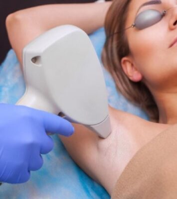 laser hair removal